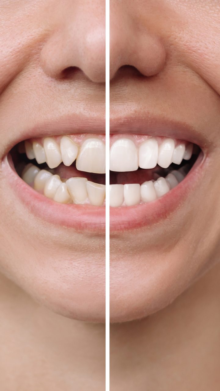 Lächelnder Mund, in der Mitte geteilt zwischen einem Vorher- und einem Nachher-Bild für Veneers
