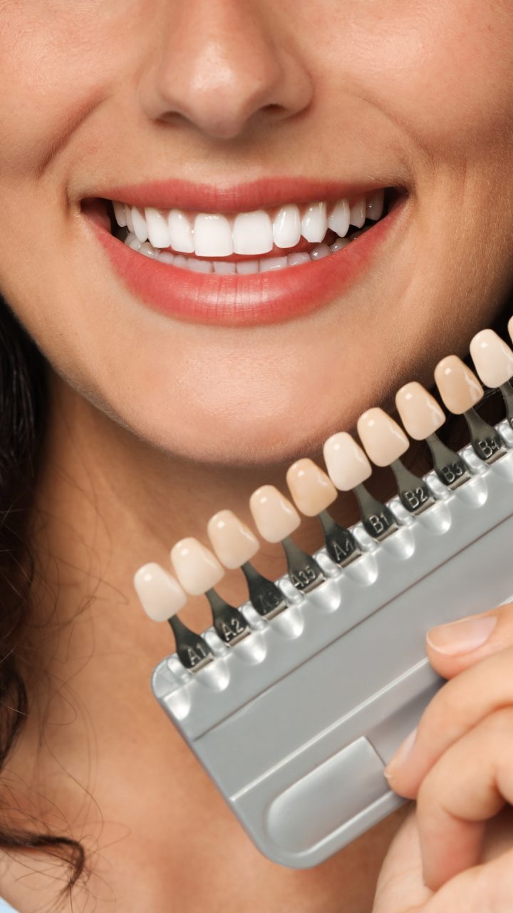Eine lächelnde Frau zeigt Veneers in verschiedenen Farbtönen
