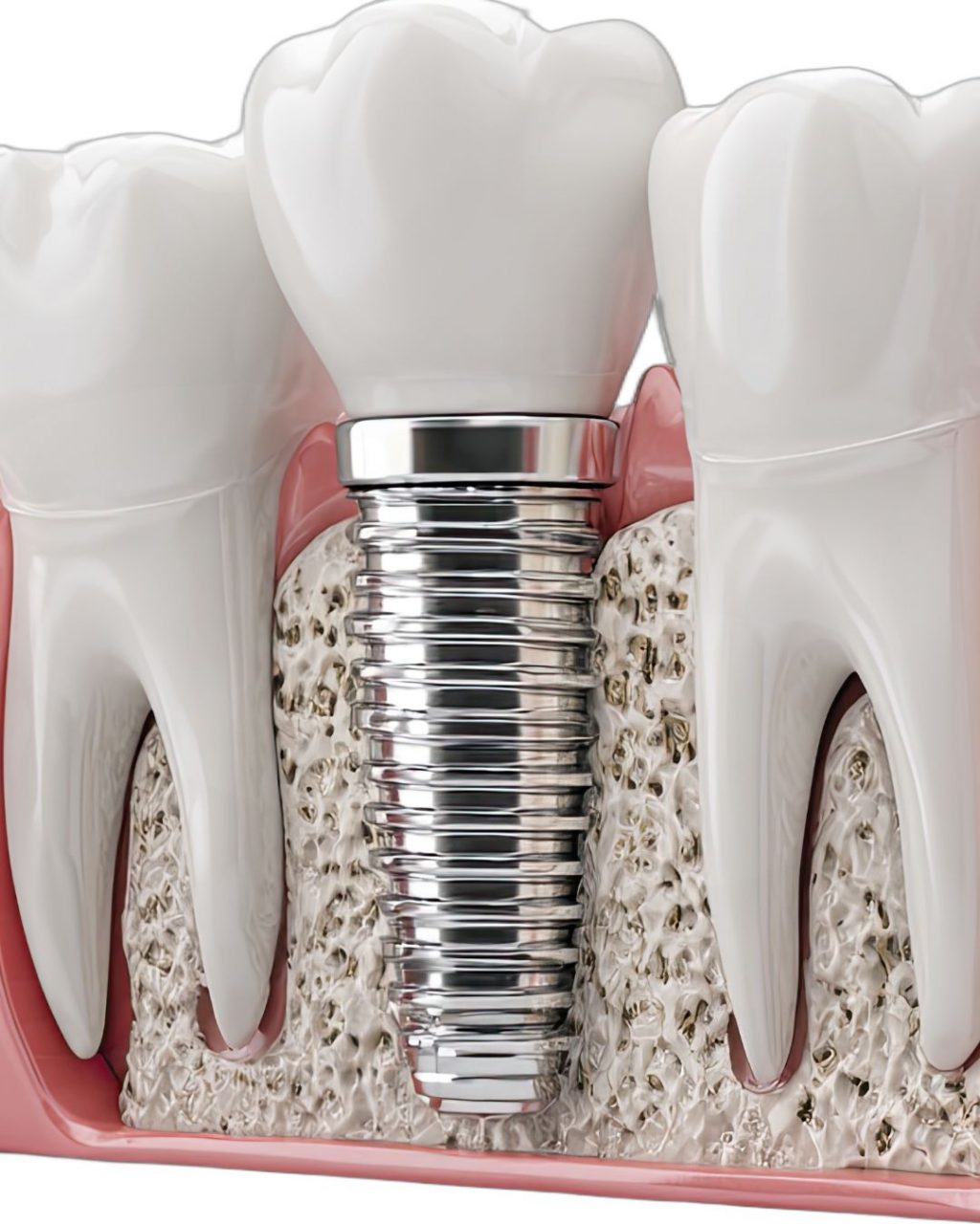 Eine Grafik, die ein Zahnimplantat zwischen zwei gesunden Zähnen zeigt