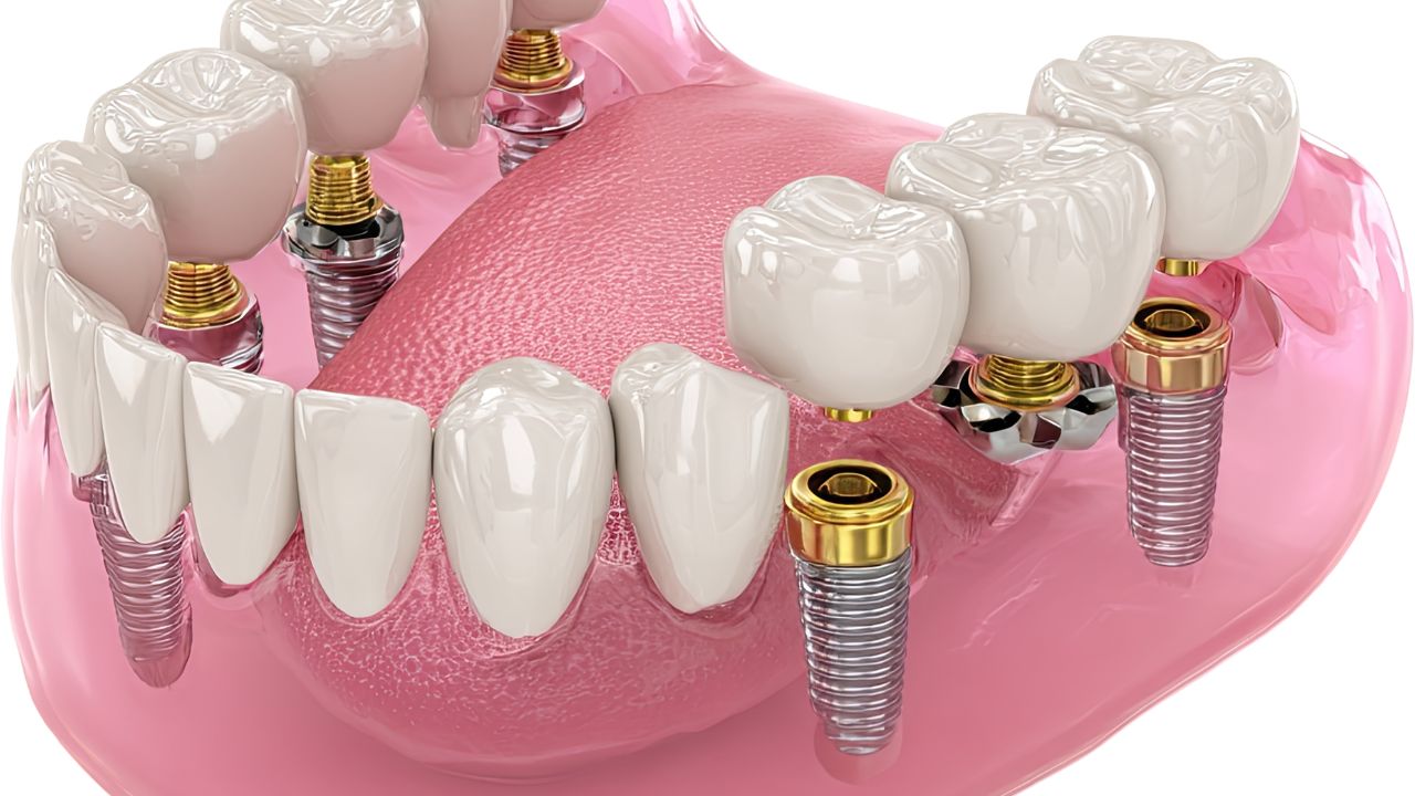 Es wird gezeigt, wie mehrere Zahnimplantate als Brückenpfeiler fungieren können